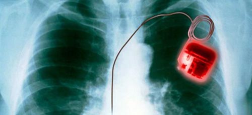 美国研究人员通过植入病毒，使豚鼠心脏具备新型起搏器功能
