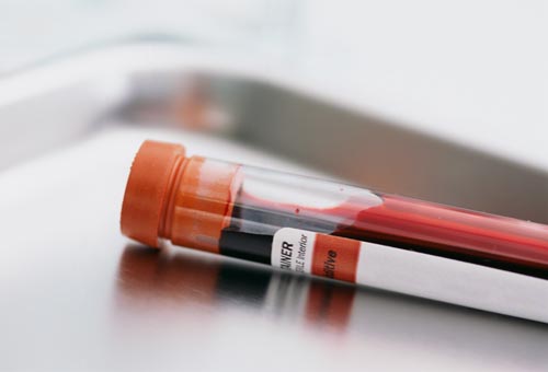 研究显示，血液测试可准确检测淋巴水肿