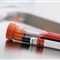 美国最新研究显示 血液测试可准确检验淋巴水肿